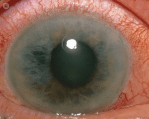 la enfermedad ocular llamada glaucoma provoca ese color en el ojo humano
